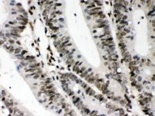 CIITA Antibody - IHC testing of FFPE human intestine cancer tissue with CIITA antibody at 1ug/ml. HIER: steam in pH6 citrate buffer and allow to cool prior to staining.