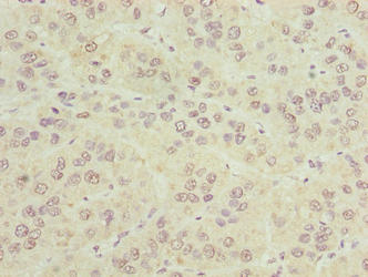 CIPC / KIAA1737 Antibody - Immunohistochemistry of paraffin-embedded human liver cancer using CIPC Antibody at dilution of 1:100