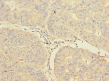 CIR1 Antibody - Immunohistochemistry of paraffin-embedded human endometrial cancer at dilution 1:100