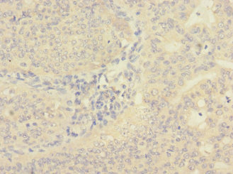CIR1 Antibody - Immunohistochemistry of paraffin-embedded human endometrial cancer at dilution 1:100