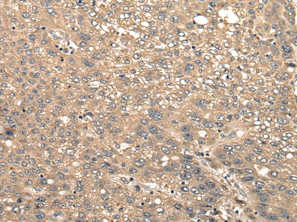 CIR1 Antibody - Immunohistochemistry of paraffin-embedded Human liver cancer tissue  using CIR1 Polyclonal Antibody at dilution of 1:40(×200)