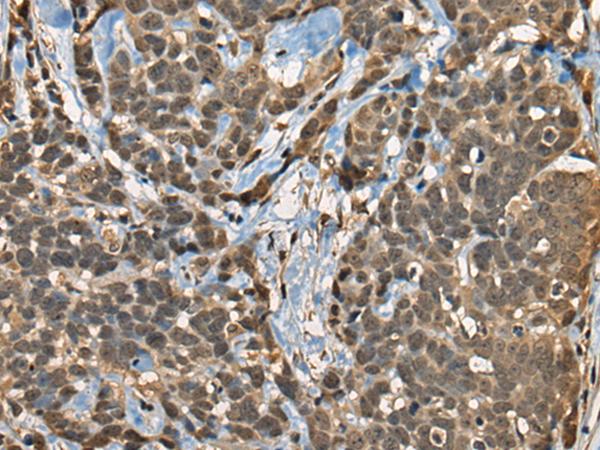 CIR1 Antibody - Immunohistochemistry of paraffin-embedded Human thyroid cancer tissue  using CIR1 Polyclonal Antibody at dilution of 1:40(×200)