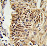 CIRP / CIRBP Antibody - CIRBP Antibody IHC of formalin-fixed and paraffin-embedded human lung carcinoma followed by peroxidase-conjugated secondary antibody and DAB staining.
