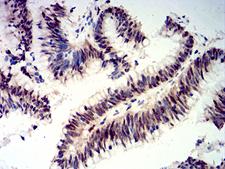 CIRP / CIRBP Antibody - Immunohistochemical analysis of paraffin-embedded colon cancer tissues using CIRBP mouse mAb with DAB staining.