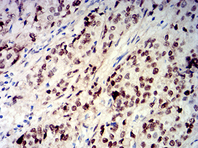 CIRP / CIRBP Antibody - Immunohistochemical analysis of paraffin-embedded bladder cancer tissues using CIRBP mouse mAb with DAB staining.