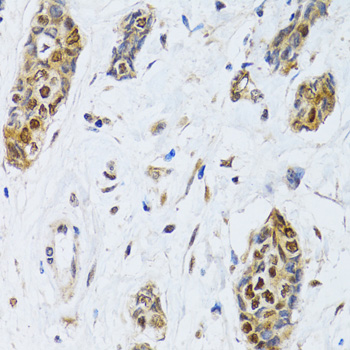 CIRP / CIRBP Antibody - Immunohistochemistry of paraffin-embedded human breast cancer tissue.