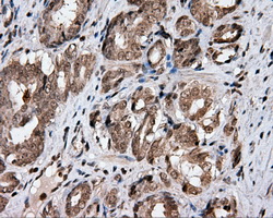 CISD1 Antibody - IHC of paraffin-embedded Carcinoma of prostate tissue using anti-CISD1 mouse monoclonal antibody. (Dilution 1:50).
