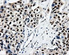 CISD1 Antibody - Immunohistochemical staining of paraffin-embedded Adenocarcinoma of breast tissue using anti-CISD1 mouse monoclonal antibody. (Dilution 1:50).