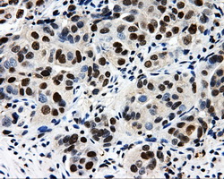 CISD1 Antibody - Immunohistochemical staining of paraffin-embedded Adenocarcinoma of ovary tissue using anti-CISD1 mouse monoclonal antibody. (Dilution 1:50).