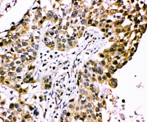 CISH / SOCS Antibody - CISH / SOCS antibody. IHC(P): Human Lung Cancer Tissue.