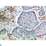 CISH / SOCS Antibody - Immunohistochemical analysis of paraffin-embedded human-lung-cancer, antibody was diluted at 1:200.