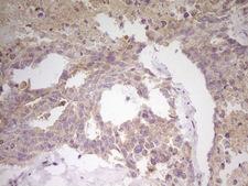 CITED1 Antibody - Immunohistochemical staining of paraffin-embedded Human testicular cancer tissue using anti-CITED1 mouse monoclonal antibody. (Heat-induced epitope retrieval by 1 mM EDTA in 10mM Tris, pH8.5, 120C for 3min,