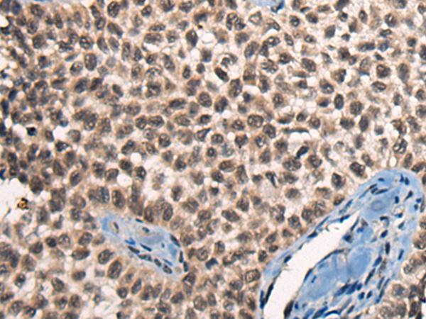 CITED2 Antibody - Immunohistochemistry of paraffin-embedded Human ovarian cancer tissue  using CITED2 Polyclonal Antibody at dilution of 1:50(×200)