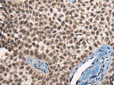 CITED2 Antibody - Immunohistochemistry of paraffin-embedded Human ovarian cancer tissue  using CITED2 Polyclonal Antibody at dilution of 1:50(×200)