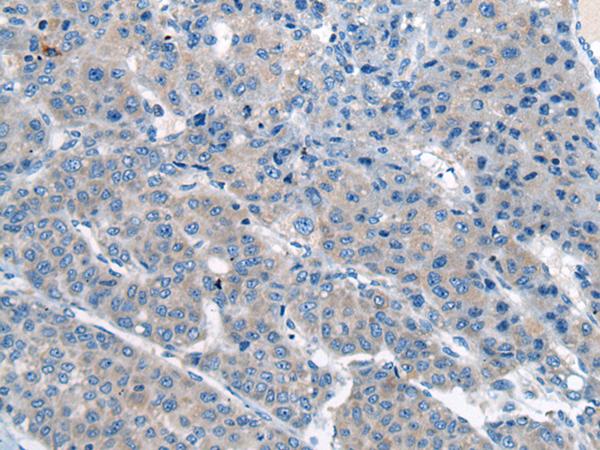 CITED4 Antibody - Immunohistochemistry of paraffin-embedded Human liver cancer tissue  using CITED4 Polyclonal Antibody at dilution of 1:65(×200)