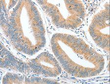 CKAP2 Antibody - Immunohistochemistry of paraffin-embedded Human ovarian cancer using CKAP2 Polyclonal Antibody at dilution of 1:50.