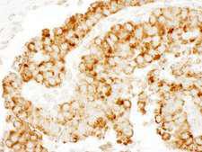 CKAP4 Antibody - Detection of Human CKAP4 by Immunohistochemistry. Sample: FFPE section of human breast carcinoma. Antibody: Affinity purified rabbit anti-CKAP4 used at a dilution of 1:200 (1 ug/ml).
