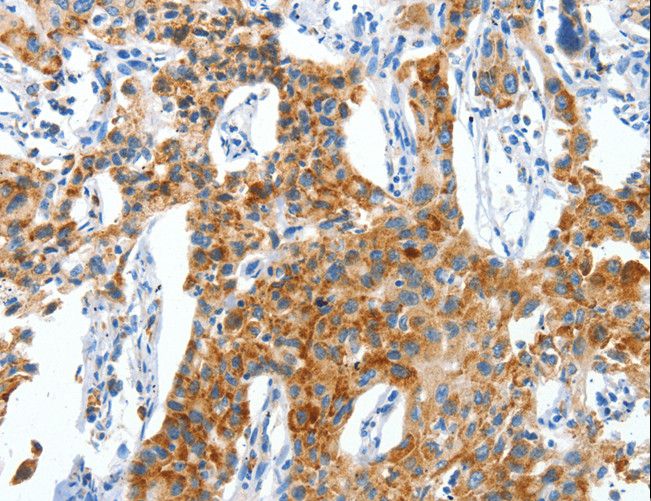 CKAP4 Antibody - Immunohistochemistry of paraffin-embedded Human lung cancer using CKAP4 Polyclonal Antibody at dilution of 1:50.