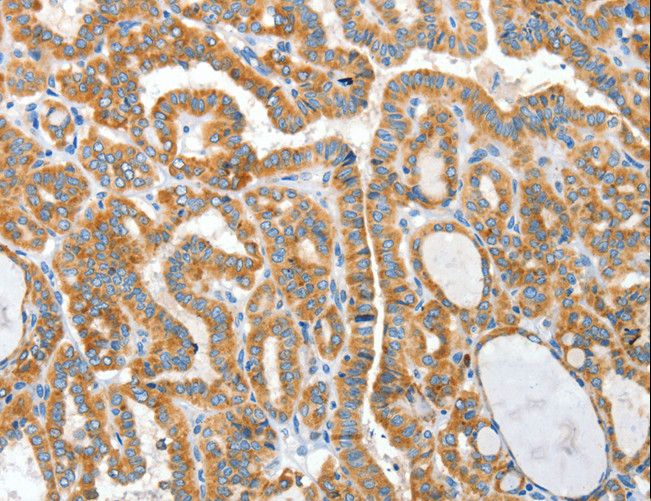 CKAP4 Antibody - Immunohistochemistry of paraffin-embedded Human thyroid cancer using CKAP4 Polyclonal Antibody at dilution of 1:50.