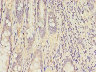 CKB / Creatine Kinase BB Antibody - Immunohistochemistry of paraffin-embedded human colon cancer tissue using antibody at 1:100 dilution.  This image was taken for the unconjugated form of this product. Other forms have not been tested.