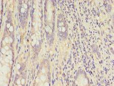 CKB / Creatine Kinase BB Antibody - Immunohistochemistry of paraffin-embedded human colon cancer tissue using antibody at 1:100 dilution.  This image was taken for the unconjugated form of this product. Other forms have not been tested.