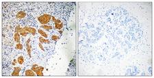 CKLFSF4 / CMTM4 Antibody - Peptide - + Immunohistochemistry analysis of paraffin-embedded human breast carcinoma tissue, using CKLF4 antibody.