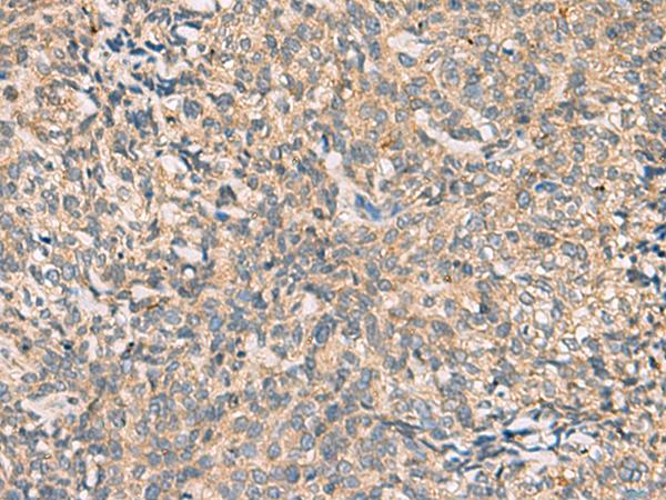CKLFSF4 / CMTM4 Antibody - Immunohistochemistry of paraffin-embedded Human cervical cancer tissue  using CMTM4 Polyclonal Antibody at dilution of 1:55(×200)