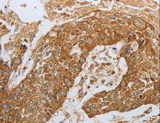 CKM / Creatine Kinase MM Antibody - Immunohistochemistry of paraffin-embedded Human esophagus cancer using CKM Polyclonal Antibody at dilution of 1:50.
