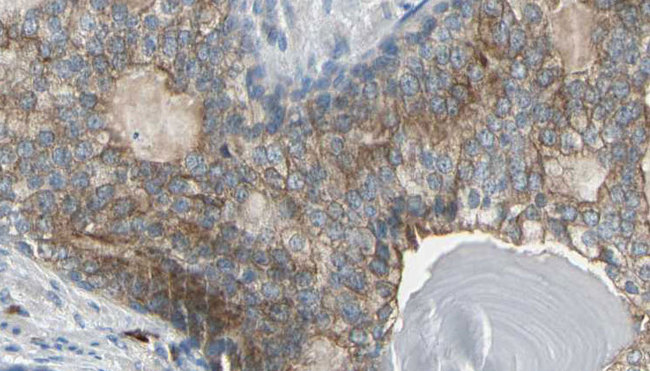 CKM / Creatine Kinase MM Antibody - 1:100 staining human prostate tissue by IHC-P. The sample was formaldehyde fixed and a heat mediated antigen retrieval step in citrate buffer was performed. The sample was then blocked and incubated with the antibody for 1.5 hours at 22°C. An HRP conjugated goat anti-rabbit antibody was used as the secondary.