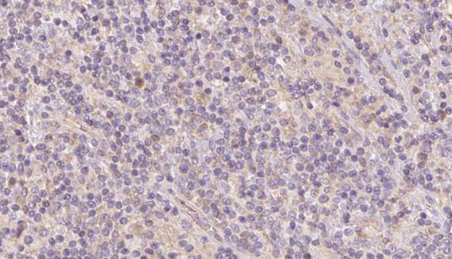 CKMT1 Antibody - 1:100 staining human lymph carcinoma tissue by IHC-P. The sample was formaldehyde fixed and a heat mediated antigen retrieval step in citrate buffer was performed. The sample was then blocked and incubated with the antibody for 1.5 hours at 22°C. An HRP conjugated goat anti-rabbit antibody was used as the secondary.