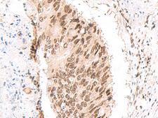 CKMT1B Antibody - Immunohistochemistry of paraffin-embedded Human colorectal cancer tissue  using CKMT1A/CKMT1B Polyclonal Antibody at dilution of 1:55(×200)