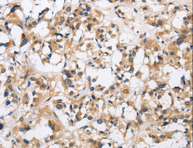 CKMT2 Antibody - Immunohistochemistry of paraffin-embedded Human thyroid cancer using CKMT2 Polyclonal Antibody at dilution of 1:60.