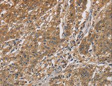 CKMT2 Antibody - Immunohistochemistry of paraffin-embedded Human gastric cancer using CKMT2 Polyclonal Antibody at dilution of 1:60.