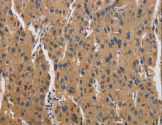 CKMT2 Antibody - Immunohistochemistry of paraffin-embedded Human liver cancer using CKMT2 Polyclonal Antibody at dilution of 1:60.