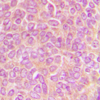 CLASP1 Antibody - Immunohistochemical analysis of CLASP1 staining in human breast cancer formalin fixed paraffin embedded tissue section. The section was pre-treated using heat mediated antigen retrieval with sodium citrate buffer (pH 6.0). The section was then incubated with the antibody at room temperature and detected using an HRP-conjugated compact polymer system. DAB was used as the chromogen. The section was then counterstained with hematoxylin and mounted with DPX.