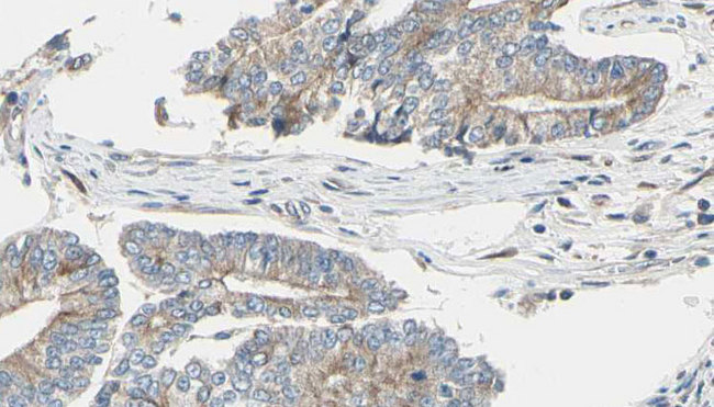 CLASP1 Antibody - 1:100 staining human prostate tissue by IHC-P. The sample was formaldehyde fixed and a heat mediated antigen retrieval step in citrate buffer was performed. The sample was then blocked and incubated with the antibody for 1.5 hours at 22°C. An HRP conjugated goat anti-rabbit antibody was used as the secondary.