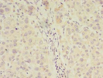 CLASP2 Antibody - Immunohistochemistry of paraffin-embedded human liver cancer tissue using antibody at 1:100 dilution.