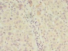 CLASP2 Antibody - Immunohistochemistry of paraffin-embedded human liver cancer tissue using antibody at 1:100 dilution.
