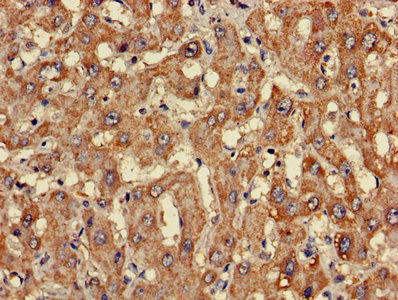 CLASP2 Antibody - Immunohistochemistry of paraffin-embedded human liver cancer using CLASP2 Antibody at dilution of 1:100