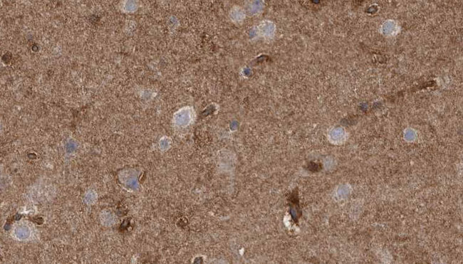 ClC-3 / CLCN3 Antibody - 1:100 staining human brain carcinoma tissue by IHC-P. The sample was formaldehyde fixed and a heat mediated antigen retrieval step in citrate buffer was performed. The sample was then blocked and incubated with the antibody for 1.5 hours at 22°C. An HRP conjugated goat anti-rabbit antibody was used as the secondary.