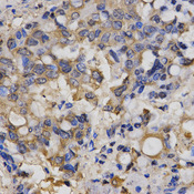 ClC-5 / CLCN5 Antibody - Immunohistochemistry of paraffin-embedded human lung cancer using CLCN5 antibody at dilution of 1:200 (x400 lens).