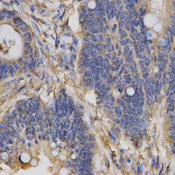 ClC-5 / CLCN5 Antibody - Immunohistochemistry of paraffin-embedded human rectal cancer using CLCN5 antibody at dilution of 1:200 (x400 lens)