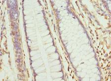 CLC-7 / CLCN7 Antibody - Immunohistochemistry of paraffin-embedded human colon cancer at dilution 1:100
