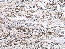 CLC-7 / CLCN7 Antibody - Immunohistochemistry of paraffin-embedded Human breast cancer tissue  using CLCN7 Polyclonal Antibody at dilution of 1:105(×200)