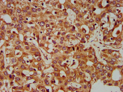CLCC1 Antibody - Immunohistochemistry Dilution at 1:400 and staining in paraffin-embedded human liver cancer performed on a Leica BondTM system. After dewaxing and hydration, antigen retrieval was mediated by high pressure in a citrate buffer (pH 6.0). Section was blocked with 10% normal Goat serum 30min at RT. Then primary antibody (1% BSA) was incubated at 4°C overnight. The primary is detected by a biotinylated Secondary antibody and visualized using an HRP conjugated SP system.