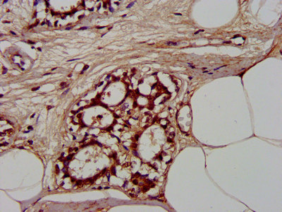 CLCNKB Antibody - Immunohistochemistry image at a dilution of 1:300 and staining in paraffin-embedded human breast cancer performed on a Leica BondTM system. After dewaxing and hydration, antigen retrieval was mediated by high pressure in a citrate buffer (pH 6.0) . Section was blocked with 10% normal goat serum 30min at RT. Then primary antibody (1% BSA) was incubated at 4 °C overnight. The primary is detected by a biotinylated secondary antibody and visualized using an HRP conjugated SP system.