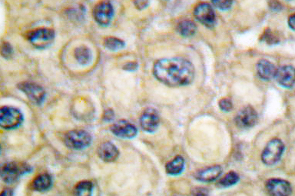 CLDN1 / Claudin 1 Antibody - IHC of Claudin 1 (R197) pAb in paraffin-embedded human breast carcinoma tissue.