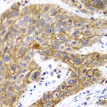 CLDN1 / Claudin 1 Antibody - Immunohistochemistry of paraffin-embedded human lung cancer tissue.