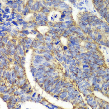 CLDN1 / Claudin 1 Antibody - Immunohistochemistry of paraffin-embedded human colon carcinoma tissue.