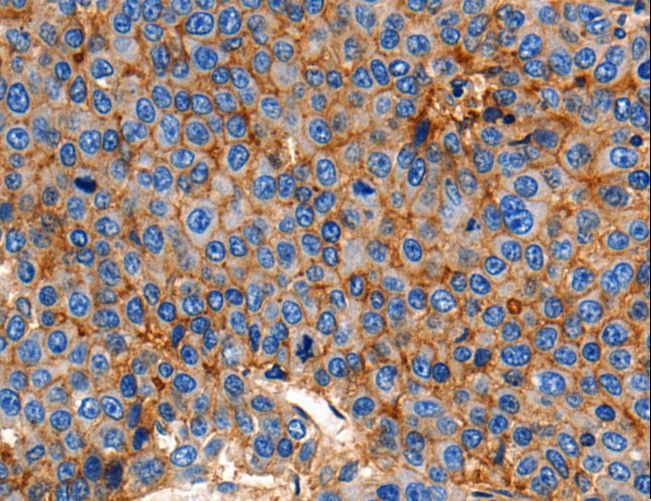 CLDN1 / Claudin 1 Antibody - Immunohistochemistry of paraffin-embedded Human esophagus cancer using CLDN1 Polyclonal Antibody at dilution of 1:150.